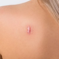Hegek a bőrön: ezekkel az eljárásokkal lehet eltüntetni, halványítani őket
