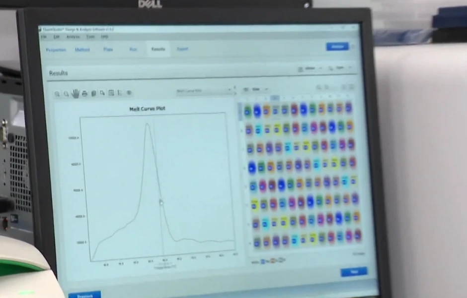 Signal da dete ima spinalnu mišićnu atrofiju (SMA)