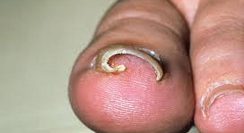 Ingrown toenail (Credit - MedicineNet)