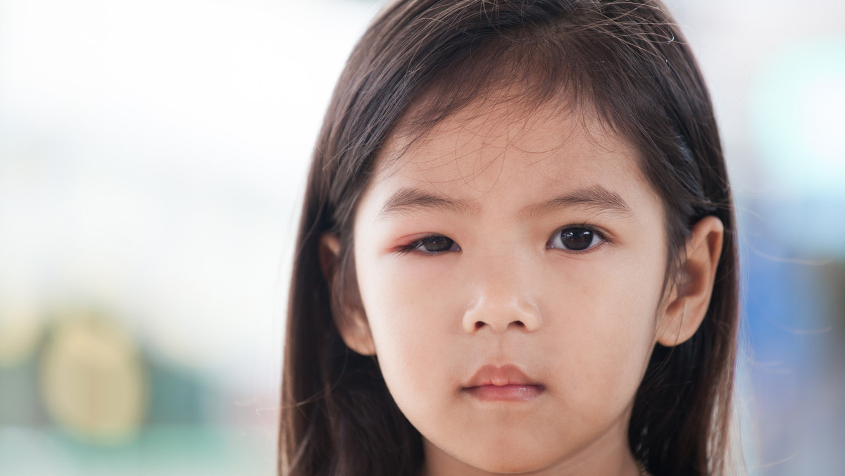 Podpuchnięte oko u dziecka: co robić? Przyczyny, domowe sposoby, alergia