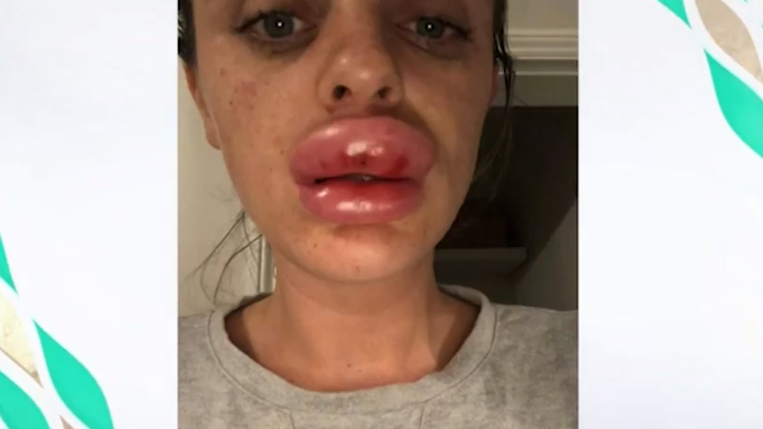 Félresikerült a botoxos kezelés: négyszeresére dagadt egy fiatal nő szája –  durva videó - Blikk