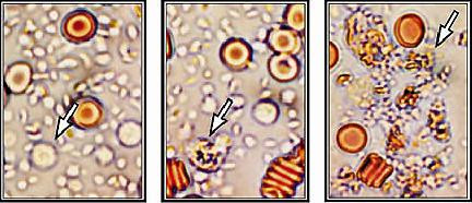 <P>Sposób w jaki alergizujące produkty niszczą białe krwinki w ludzkim ustroju:<STRONG>
</STRONG></P><P>Ilustracja po lewej: mikroskopowy obraz zdrowych białych komórek krwi, obserwowanych podczas wykonywania testu, w zetknięciu z produktem (groch), na k
