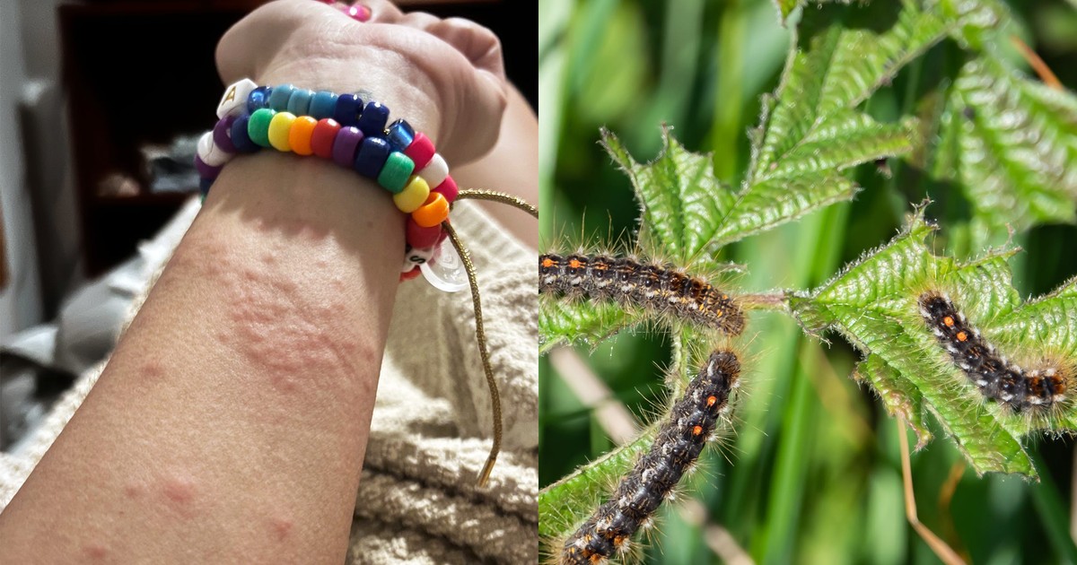I woke up covered in a painful rash. A caterpillar with toxic hairs was ...