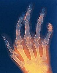 rheumatoid-arthritis-d0000105D7ccc3c138fa5