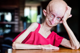 Bea ovde ima 19 GODINA! Rođena je sa bolešću koju ima 1 u 4 MILIONA BEBA, pa počela da obara rekorde u dužini života: Postala je senzacija, a juče su stigle STRAŠNE VESTI