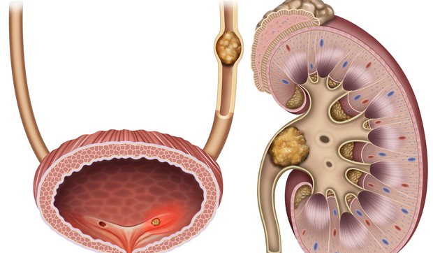 Kamen u bubregu može putem mokraćnih kanala da dođe do bešike