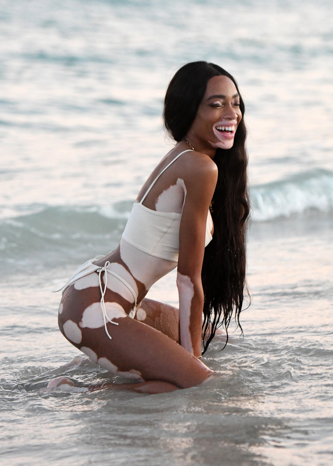 Winnie Harlow nie wstydzi się swojej choroby. Dumnie pozuje do zdjęć