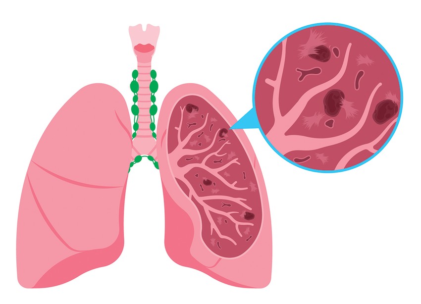 Ožiljci u plućima su isključivo stečeni