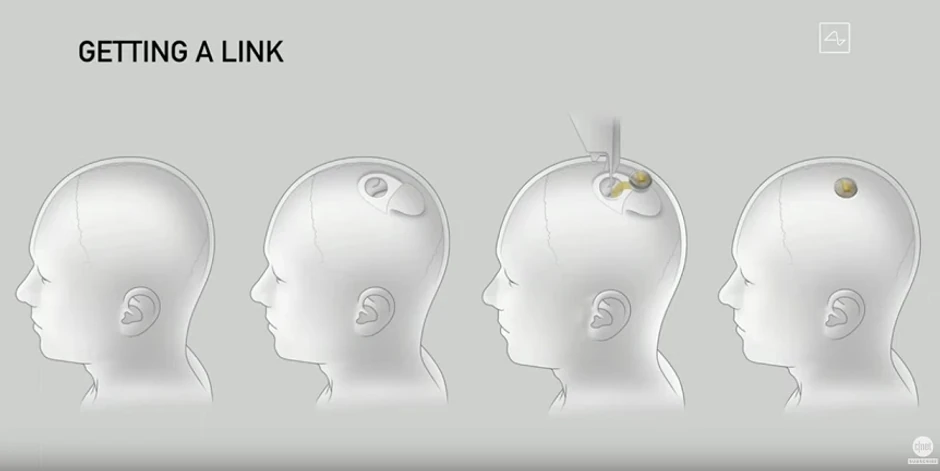 Maskov čip na ljudskom mozgu