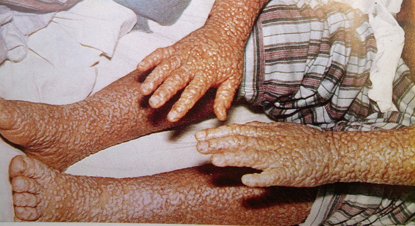 Bolest se širi sve do fatalnog ishoda....