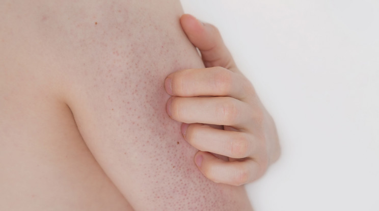 Keratosis pilaris / Fotó :Shutterstock