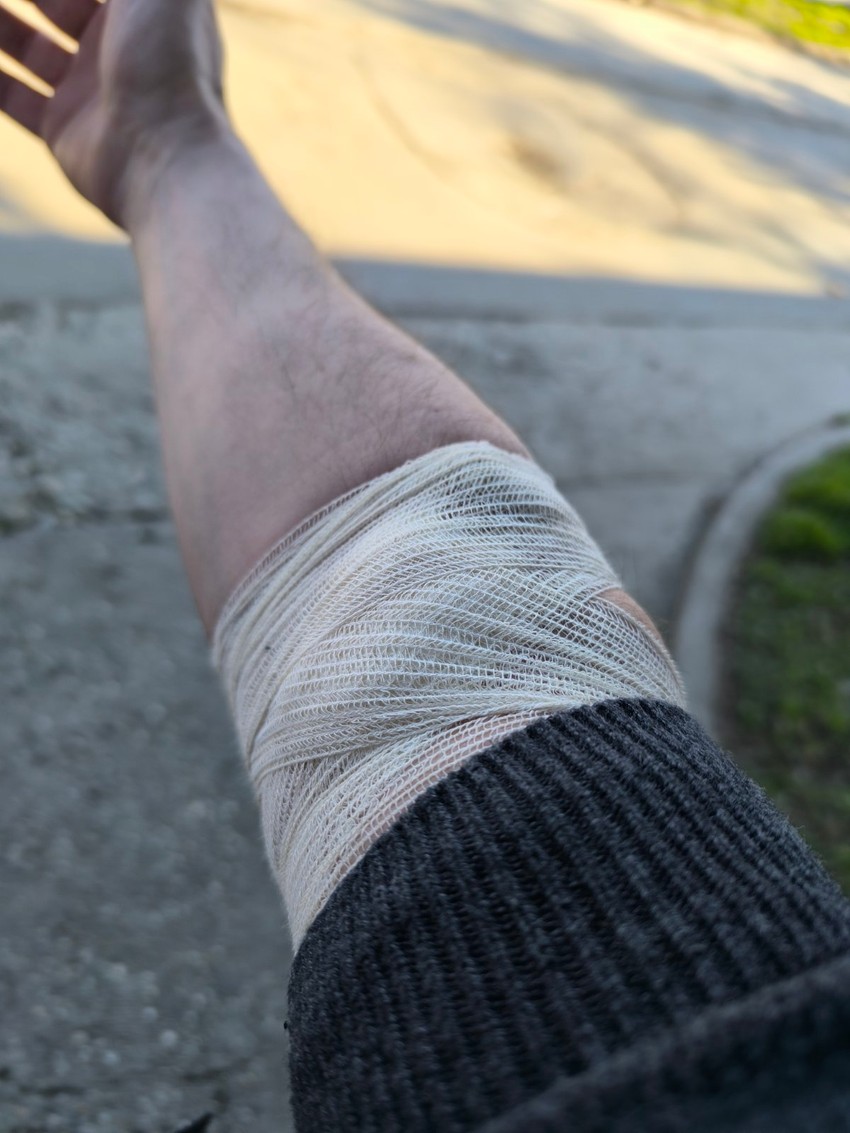 Fotografija ruke osobe koja je donirala matične ćelije