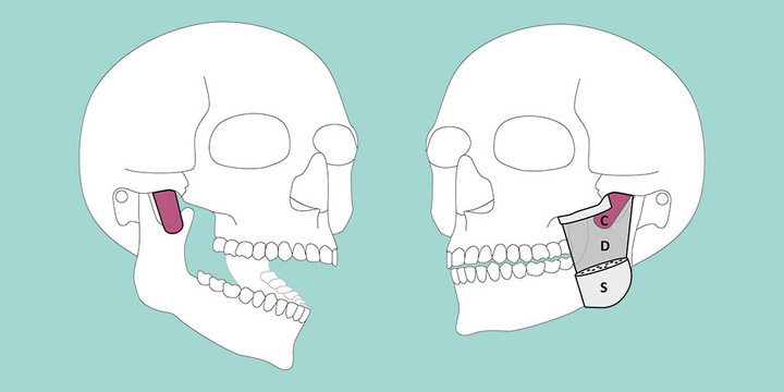 Illustration Masseter neu 1000x500