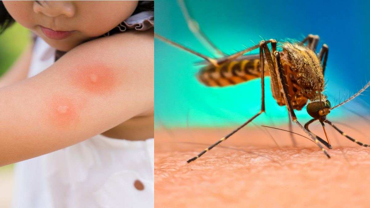 Komary. Jak zmniejszyć uczucie swędzenia po ukąszeniu? Domowy sposób