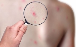 Kolejne ognisko odry. Pomorski Sanepid: To obcokrajowcy zatrudnieni w dużym zakładzie