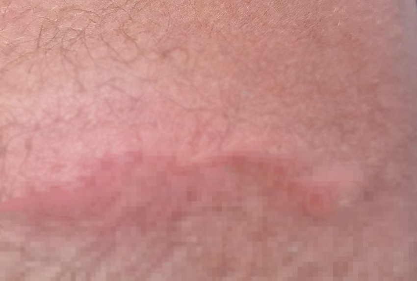 Krateri koji nastaju na koži mogu ostati mesecima