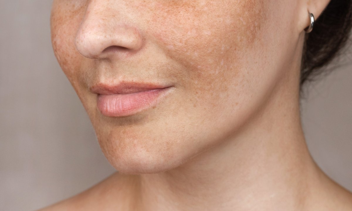 TOP 3 kremy na brązowe przebarwienia. Działają jak ścierająca gumka choćby na plamki starcze