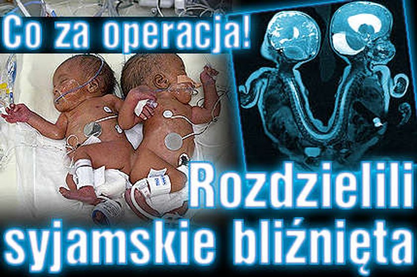 Co za operacja! Rozdzielili syjamskie bliźnięta