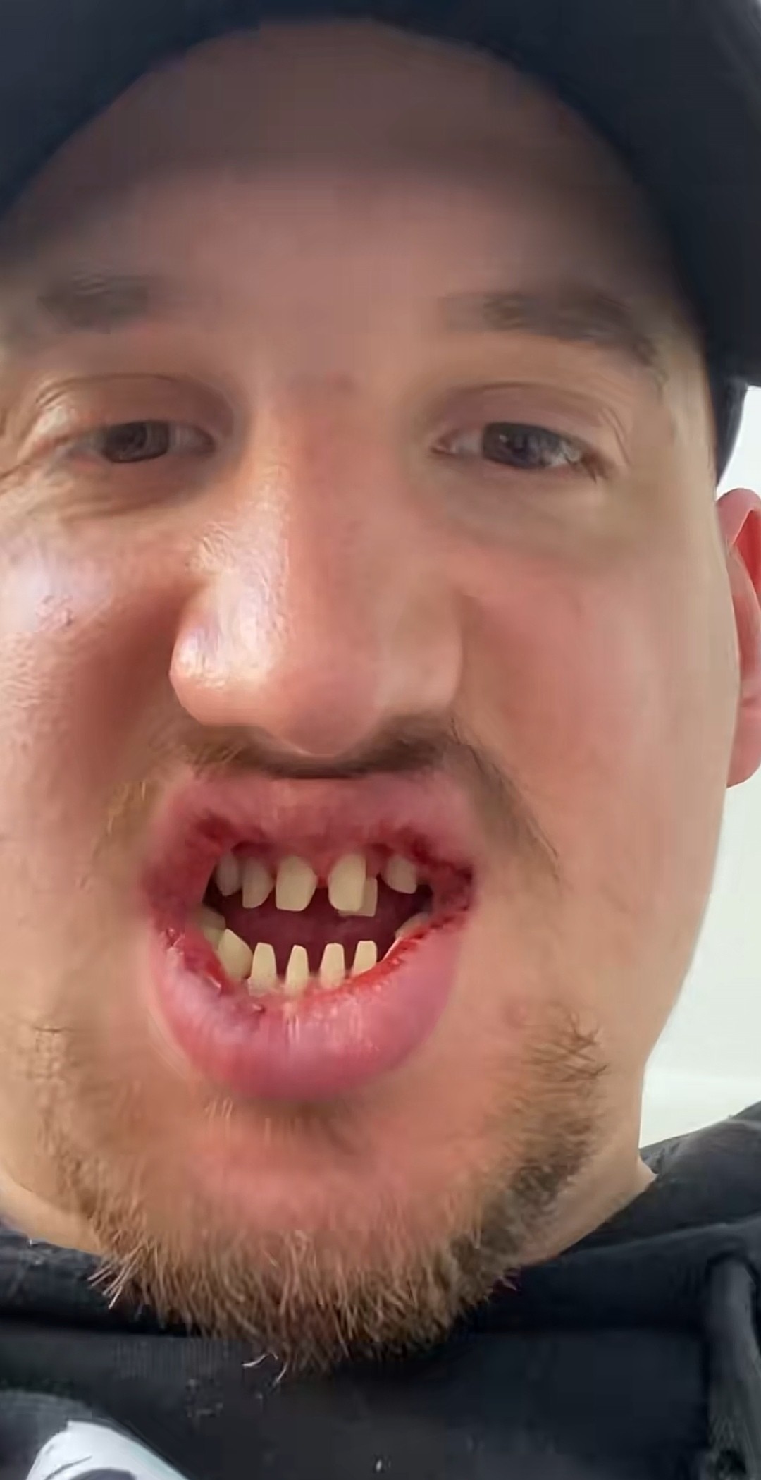 Dustin sa na TikToku pochválil svojím novým chrupom. 