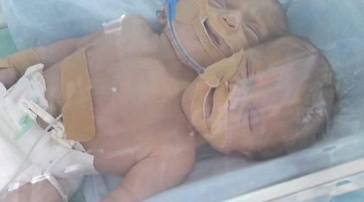 Gázában születettek a ritka ikrek/Fotó-Liveleak