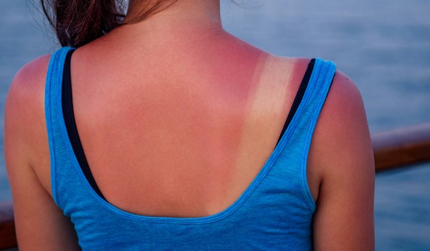 sorti_opekotine_od_sunca_lecenje_vesti_blic_safe_sto