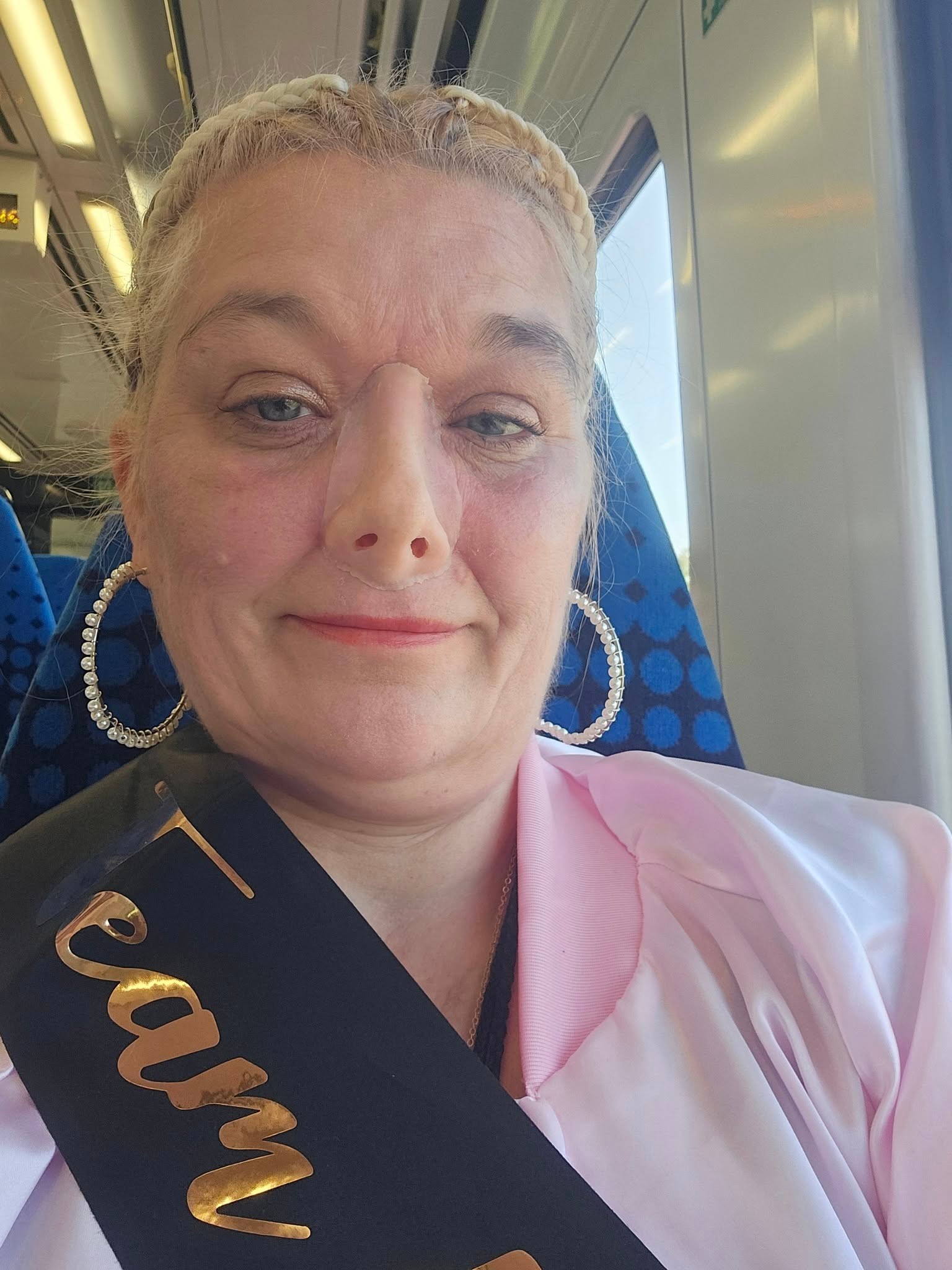 Ellen teraz nosí umelý nos.