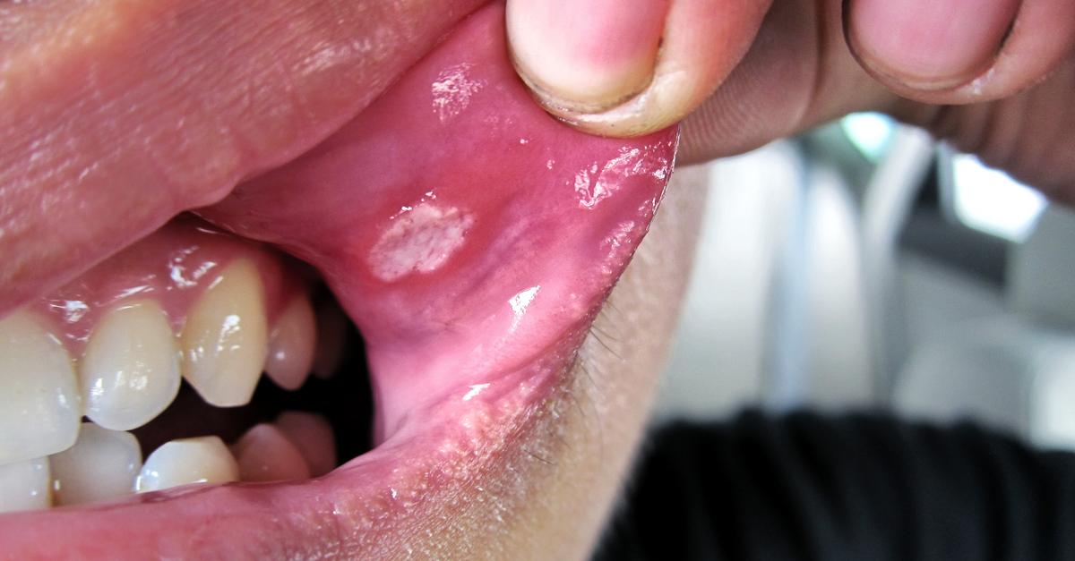 Zapalenie Jamy Ustnej Choroby Cywilizacyjne
