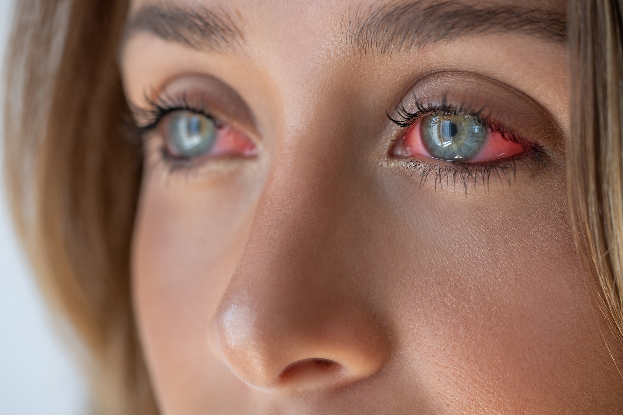 Winking is important for eye health. (illustration photo)