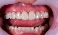 Wybielanie zębów - jaką metodę wybrać?