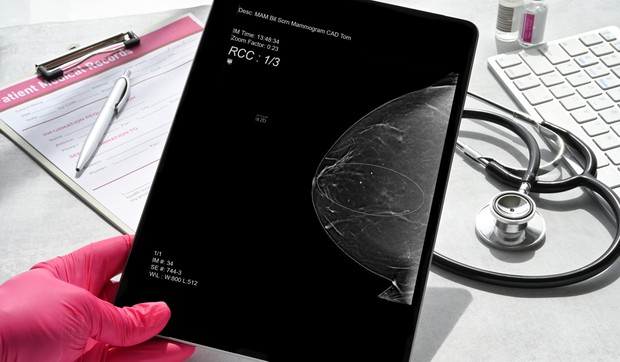 Metaplastični rak dojke je jedan od najagresivnijih oblika ove bolesti