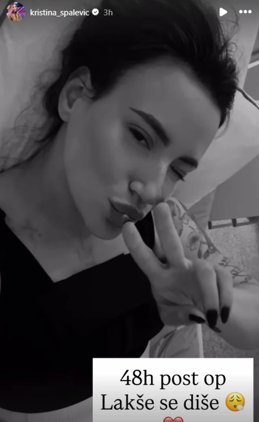 "LAKŠE SE DIŠE!" Kristina Spalević POKAZALA REZULTAT OPERACIJE nakon 48 sati, evo šta je sve korigovala na sebi (FOTO)