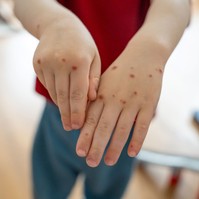 Járvány Ukrajnában: miért veszélyes a Coxsackie-vírus, és miről ismerhetők fel a tünetei?