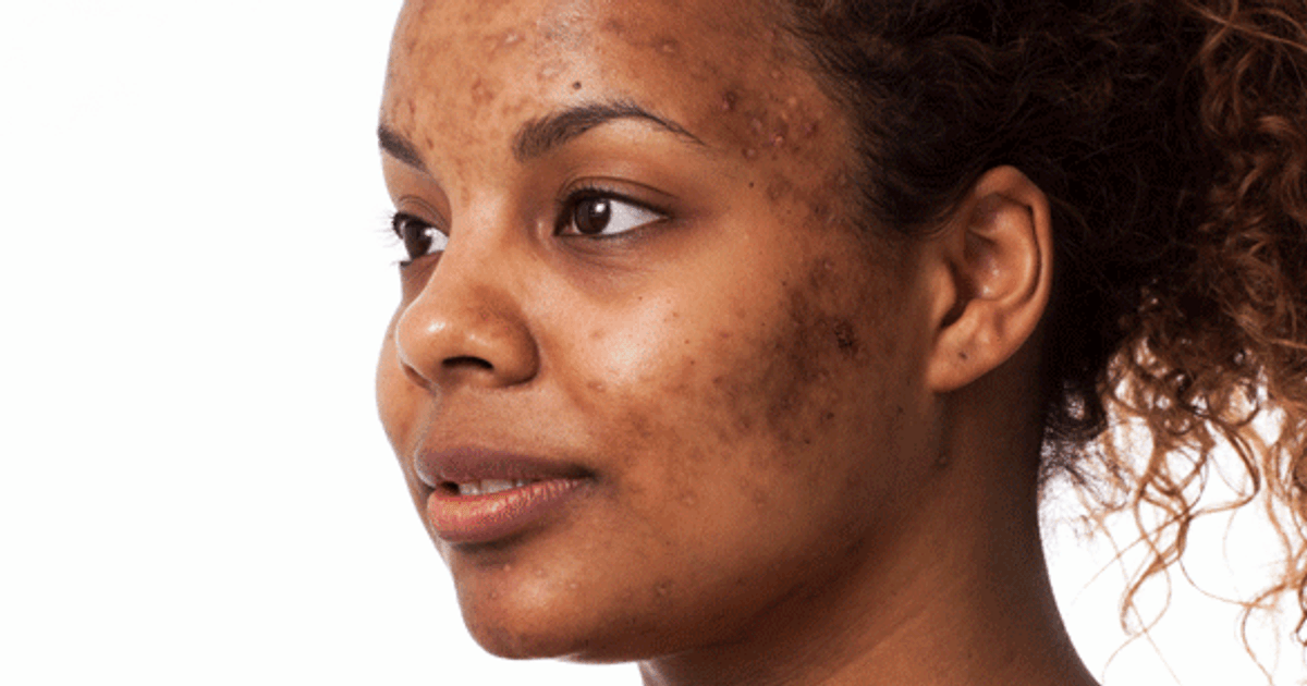 How Nigerian skincare merchants were exposed for damaging people's skin - Vimarsana News