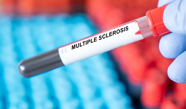 Svaki novi lek koji uzimaju oboleli od multiple skleroze, mora da bude usklađen sa osnovnom terapijom