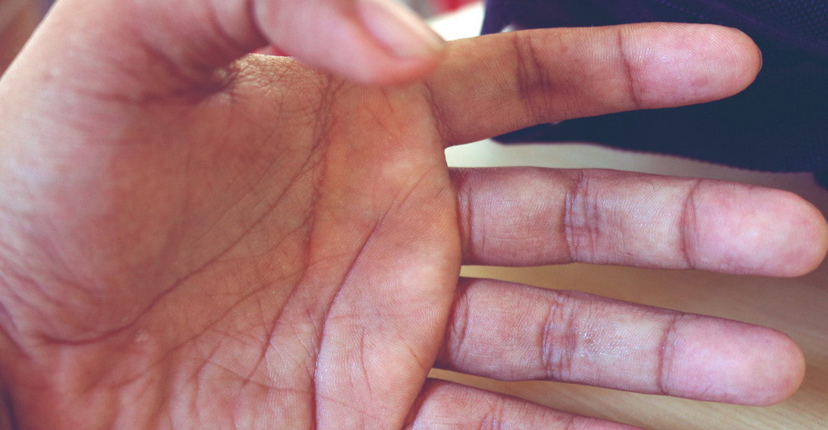 Pocenie dłoni może być objawem zapowiadającym zawał serca