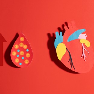 Ez az érelmeszesedés alig ismert rizikófaktora - pedig ilyen egyszerűen kimutatható a vérből