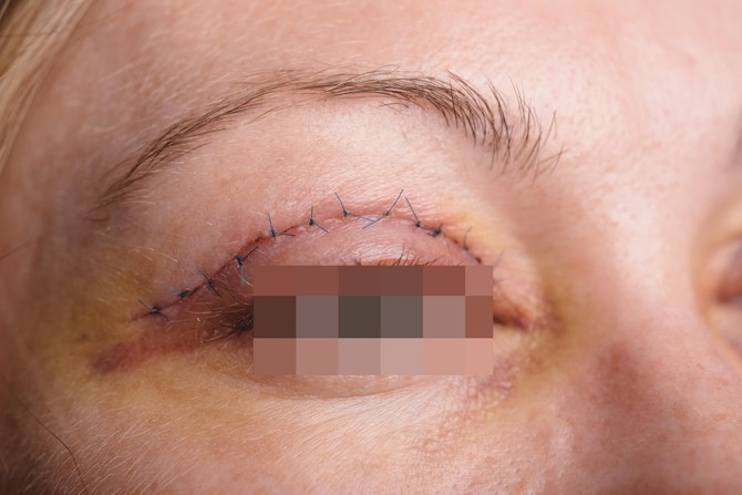 Blefaroplastika 