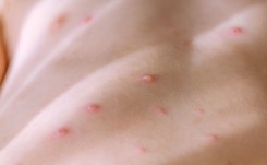 Znaczący wzrost zachorowań na ospę. OBJAWY