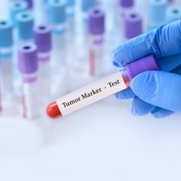 4 jelzés a leleten, mely nőgyógyászati rákra utalhat