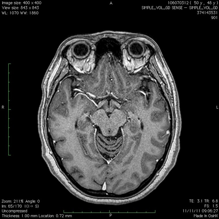 Obraz rezonansu magnetycznego mózgu bez tętniaka, listopad 2011 rok, fot. Archiwum Znaku