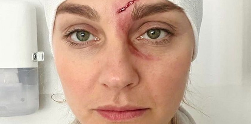 Małgorzata Socha pokazała zdjęcia pokiereszowanej twarzy. Polała się krew. Co się stało?