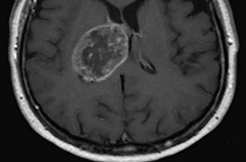 Ćelije karcinoma među zdravim ćelijama