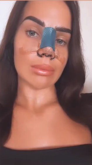 Anet Slotová po plastickej operácii nosa.