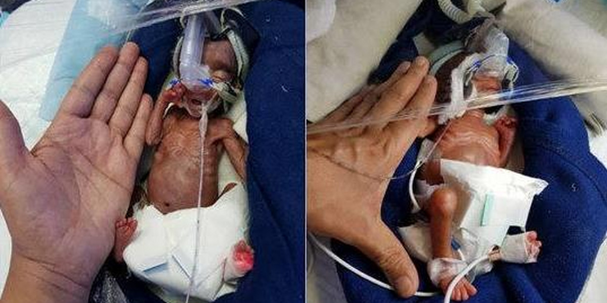 Lekarze przez 4 tygodnie walczyli o życie przedwcześnie urodzonych bliźniąt