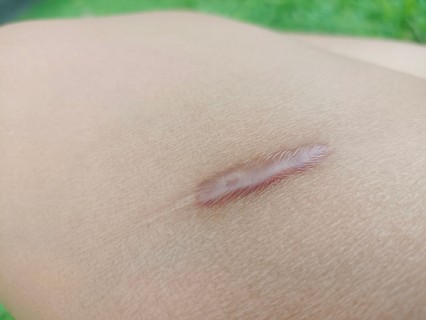 Keloid