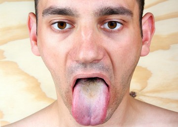 A szájpenész a candida fertőzés (candidiasis) egyik gyakori formája.