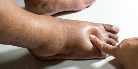 Leg swelling[Shutterstock]