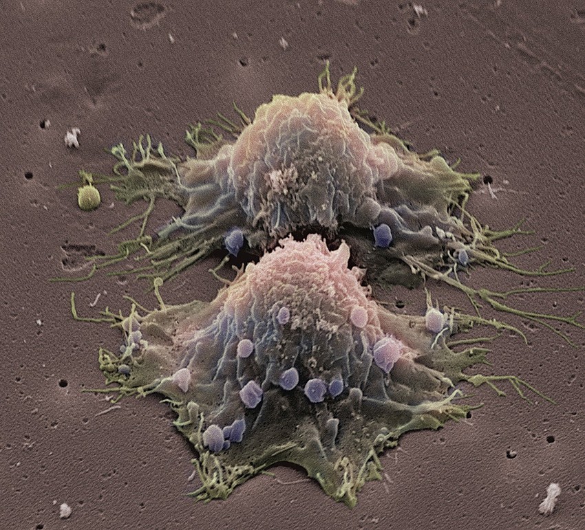 Grupe kanceroznih ćelija bile su previše male da se uoče na testovima (foto: ilustracija)