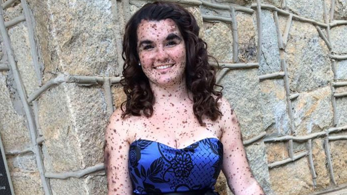 19-latka z Północnej Karoliny, która urodziła się z bardzo rzadką chorobą skóry, nauczyła się kochać swoją odmienność - informuje serwis adelaidenow.com.au.