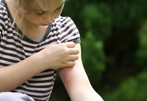 Naturalne sposoby na komary, które odstraszają nieproszonych gości